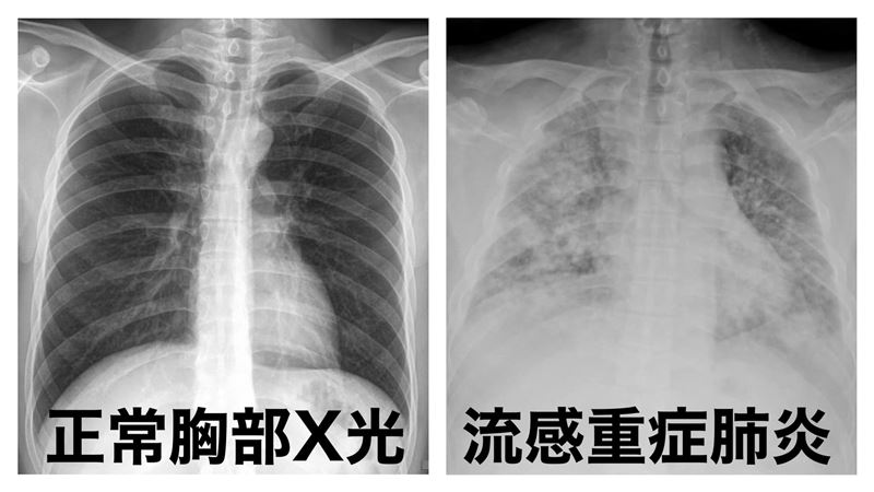 大S驟逝！「怎麼肺炎，人就走了？」流感不是感冒　醫揭一大關鍵差異